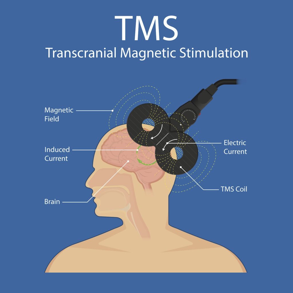 TMS therapy and treatment is a non-invasive method of brain stimulation that relies on electromagnetic induction using an insulated coil placed over the scalp