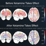 Bryan Johnson’s Ketamine Experiment