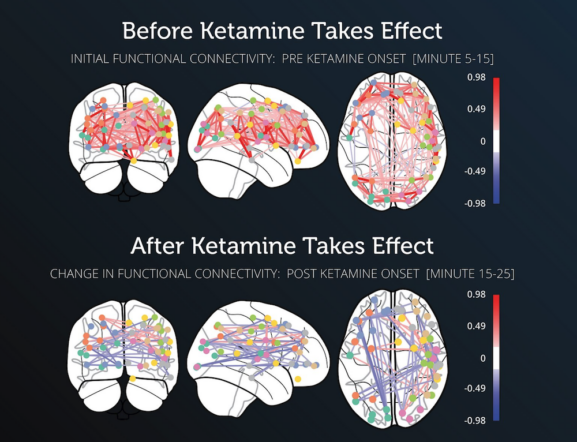 Bryan Johnson’s Ketamine Experiment