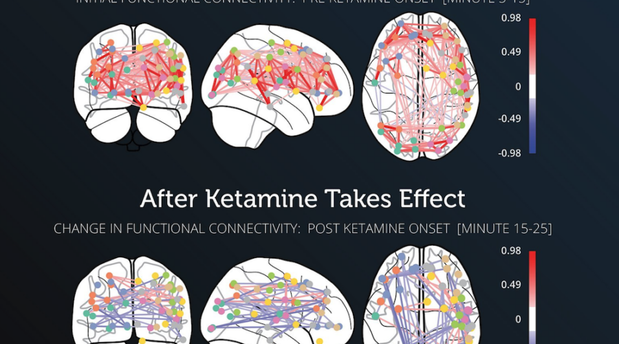 Anti-Aging Biohacker Bryan Johnson’s Ketamine Experiment